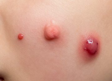 Understanding Different Types of Acne: Pimples, Boils, and Cystic Acne