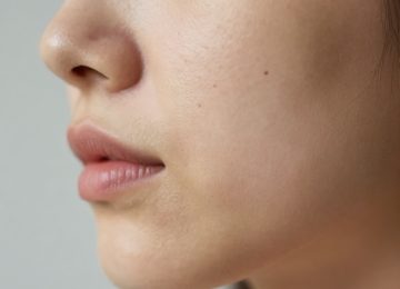 Understanding Facial Acne and Redness: A Common Skin Condition