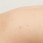 Understanding Forehead Skin Acne Blemishes and Red Bumps
