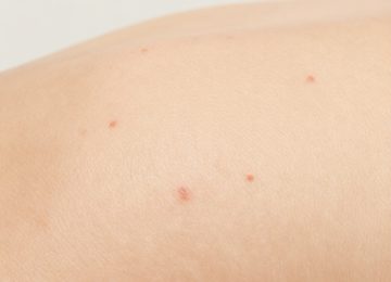 Understanding Forehead Skin Acne Blemishes and Red Bumps