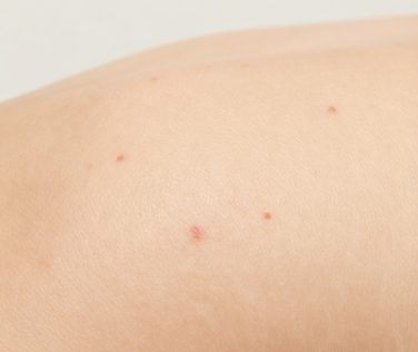 Understanding Forehead Skin Acne Blemishes and Red Bumps