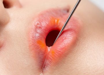 Understanding Inflamed Pores and the Process of Extraction