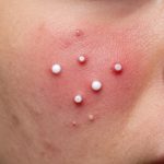 Understanding Inflamed Skin with Pustules and Irritation Up Close
