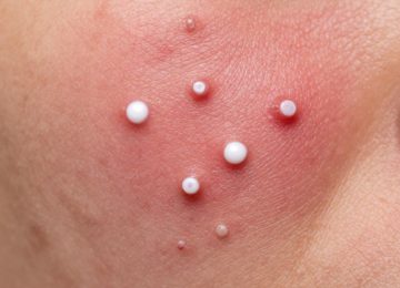 Understanding Inflamed Skin with Pustules and Irritation Up Close