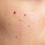 Understanding Multiple Comedones and Visible Dark Pores