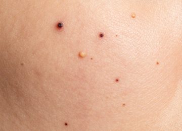Understanding Multiple Comedones and Visible Dark Pores