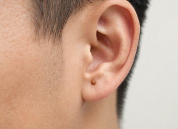 Understanding Sebaceous Cysts Located Behind the Ear: Causes and Characteristics