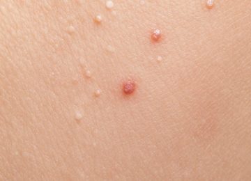 Understanding Small Raised Dermal Lesions on Human Skin