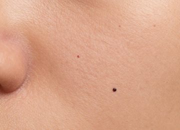 Understanding Visible Blackheads and Pores on Facial Skin