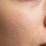 Understanding Whiteheads and Visible Pores on Blemished Skin