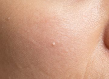 Understanding Whiteheads and Visible Pores on Blemished Skin