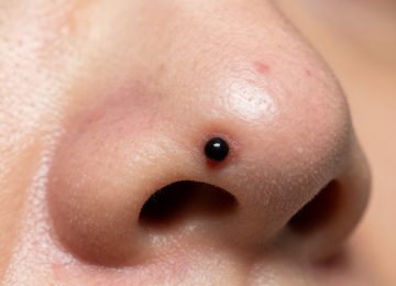 Understanding the Blackhead: A Closer Look at That Dark Pore