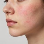 Understanding the Causes and Symptoms of Inflammatory Acne and Skin Redness