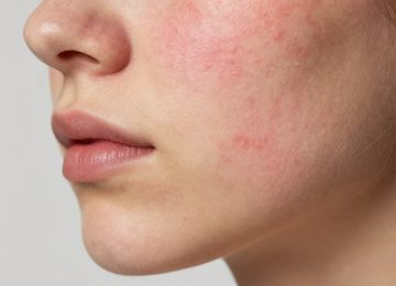Understanding the Causes and Symptoms of Inflammatory Acne and Skin Redness