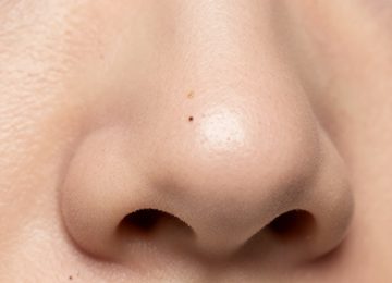 Understanding the Causes and Treatment of Nose Pores and Blackheads