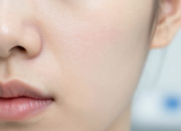 Understanding the Long-Term Results of Professional Clinical Acne Treatments