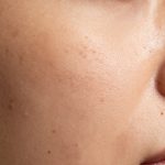 Understanding the Mechanics of Pore Congestion and Skin Surface Irregularities