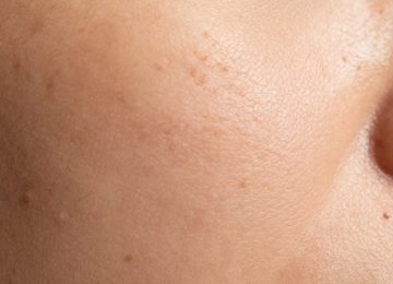 Understanding the Mechanics of Pore Congestion and Skin Surface Irregularities