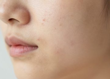 Your Practical Guide to Tackling Acne and Minimizing Scars